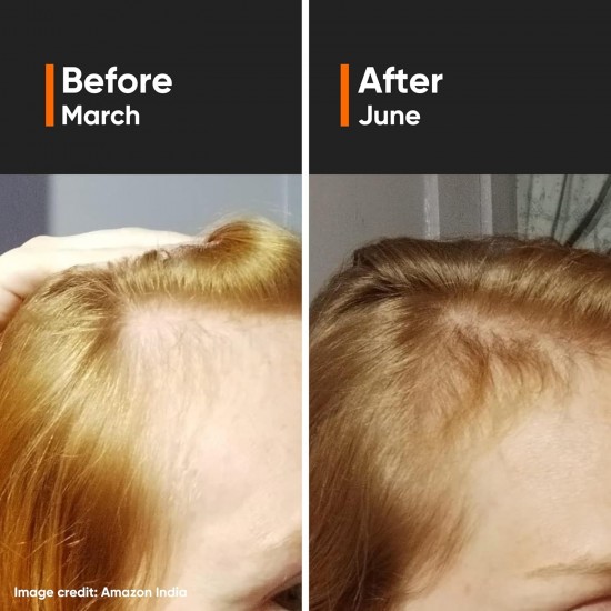 Minimalist Hair Growth Actives 18% Hair Serum 30ml